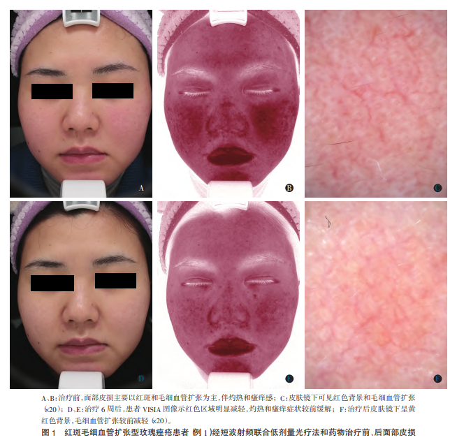 红斑毛细血管扩张型玫瑰痤疮患者